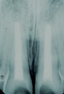 Root Fracture A tooth fracture that involves dentine, cementum & pulp Coronal, middle or apical 1/3 Horizontal / vertical May also involve crown Root fracture
