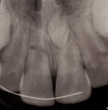 (cervical) Diagonal - common with apical third fractures, occlusal view useful Root Fracture - management No mobility Soft diet, OHI Mobility gently reposition splint