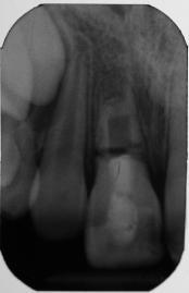 Root fill coronal portion Or Remove coronal portion Try and maintain root Crown-root fracture Fracture involves enamel, dentine & root structure Pulp may or may not be