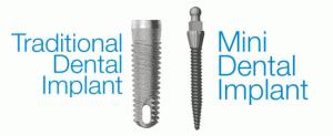 Mini Dental Implants Mini Dental Implants are an alternative to traditional Dental Implants for patients who have experienced bone loss in the jaw or are having an Implant placed in a narrow area of