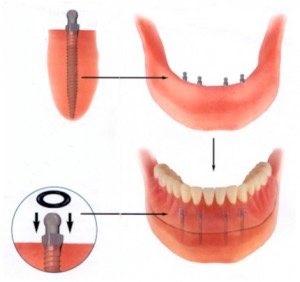 They come in different lengths, to accommodate the shape and size of each individual jaw. How are Mini Dental Implants Used? Mini Dental Implants are a single unit, with a ball, or adaptor, on top.