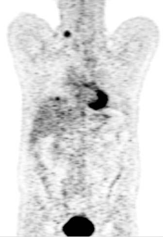 Impact of Whole-body Respiratory Gated PET/CT in worst case