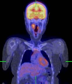 PET/CT Oncology Imaging Anatometabolic fusion images are useful in the management of patients with cancer (Wahl, JNM, 1993) PET/CT scanners are used