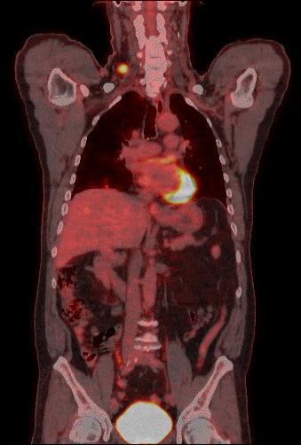 Imaging FDG uptake (PET) with anatomical localization (CT)