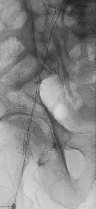 The physician initially attempts to cross the CTO ipsilaterally using a guidewire. The guidewire is not successful in crossing the CTO.