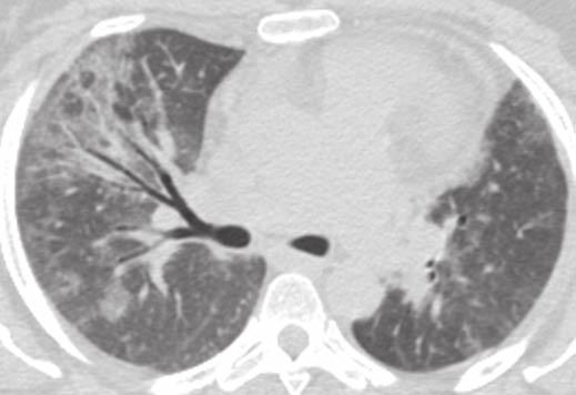 Unenhanced axial CT image through mid to lower lungs shows diffuse centrilobular ground-glass nodules bilaterally.