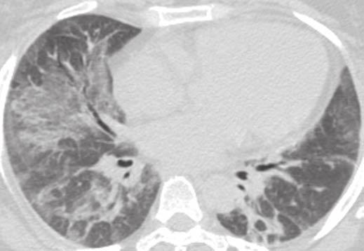 A C, Unenhanced axial CT images through upper, mid, and lower lungs show mostly ground-glass opacities, which are patchy, bilateral, and asymmetric in