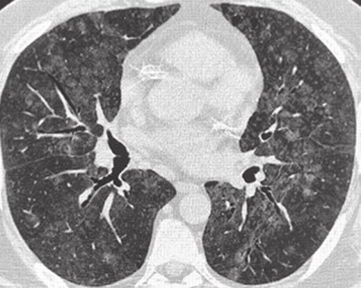 CT of Interstitial Pneumonia A C Fig.