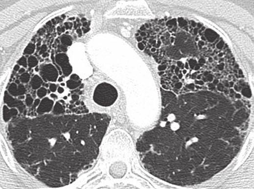 accompanied by traction bronchiectasis and scattered peripheral reticular opacities. Honeycombing is most prominent feature in this patient, typical for idiopathic pulmonary fibrosis.