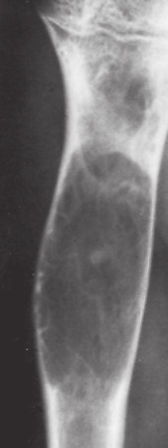 Fig. 14 Aneurysmal bone cyst. Expansile, eccentric, cystic lesion of tibia with multiple fine internal septa. Because severely thinned cortex is difficult to detect, tumor resembles malignant process.
