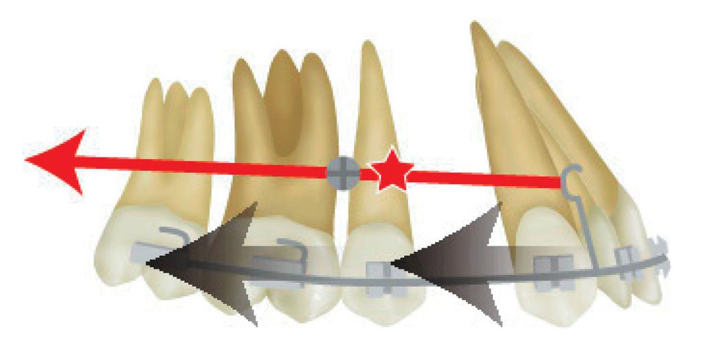 410 Fig. 1 Traction force and tooth movement. : Center of resistance (CR) of the dental arch.