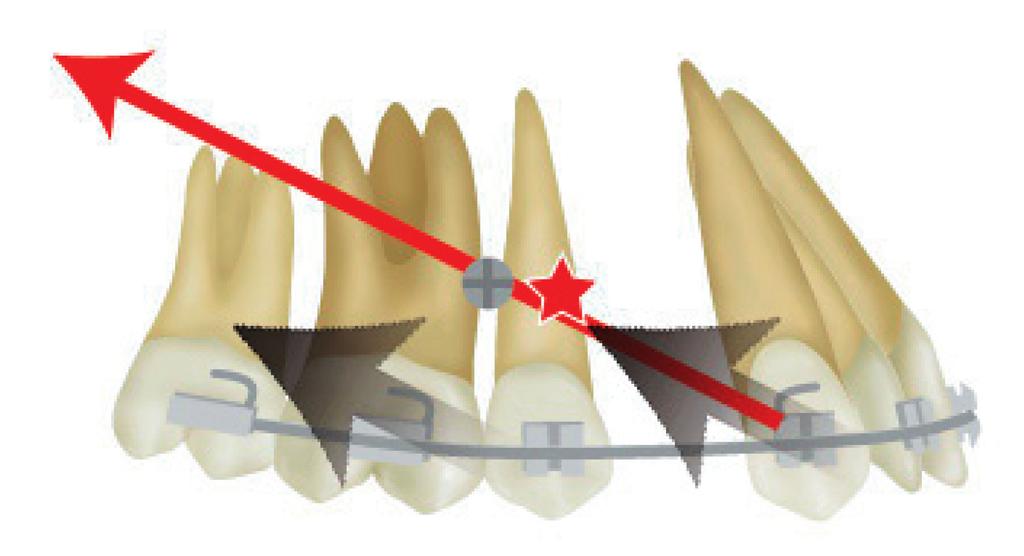 Parallel translation in the posterior direction is seen when the force vector is directed through the CR and remains parallel to the occlusal plane. Fig.