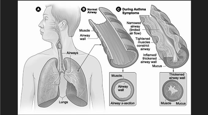 Shortness of Breath in an Athlete Asthma chronic disease, marked by recurrences, often resting or nighttime cough, allergy sx Acute illness (cold, flu) may last 2-3 wks Poor conditioning difficult to