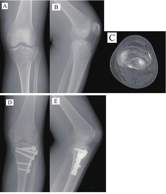 present a case series of patients with posterolateral tibial plateau fractures that were treated by the anterior surgical approach and to evaluate the functional results and complications of the