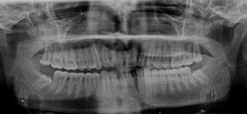 WJD Evaluation of Titanium Lag Screw Osteosynthesis in the Management of Mandibular Fractures A A B Figs 2A and B: Preoperative radiograph: (A) OPG; and (B) occlusal