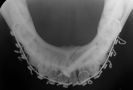(B) postoperative occlusal view to provide a smooth platform for screw-head seating.