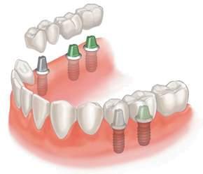 The crown is fabricated in a dental laboratory to match the surrounding teeth so that it looks as natural as possible.