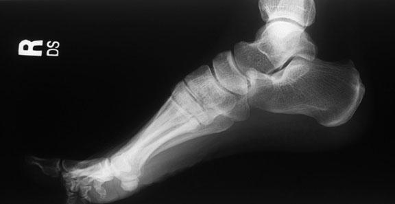 Normal Lateral Radiograph of Foot http://www.
