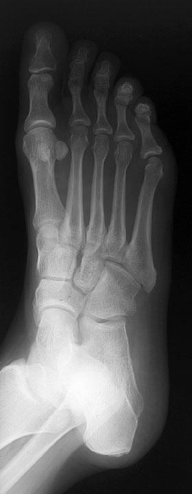 Normal Oblique Radiograph of Foot http://www.rad.washington.