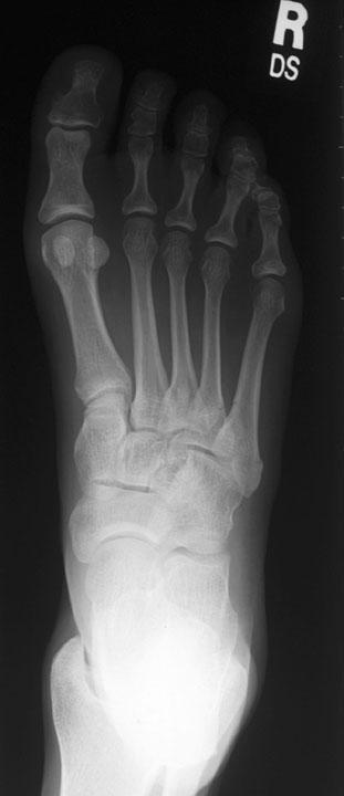 Normal AP Radiograph of the Foot http://www.rad.washington.