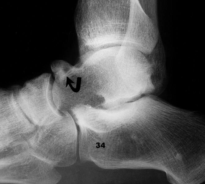 Talar Beak Secondary to impaired subtalar joint motion Represents navicular overriding the talus Periosteal elevation occurs at