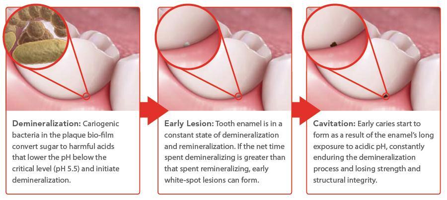 The caries process is the name given to the repeated sequence of changes going on at the junction between the outer surface of the tooth and the layer of plaque/ biofilm that builds up on teeth.