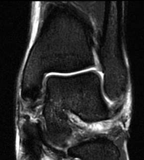 How do I scope the ankle with fracture care? 1. Can use leg holder and do scope and fx -Unilateral lithotomy leg 2. Can do set up for ankle fracture and then scope -Large bump under knee 3.