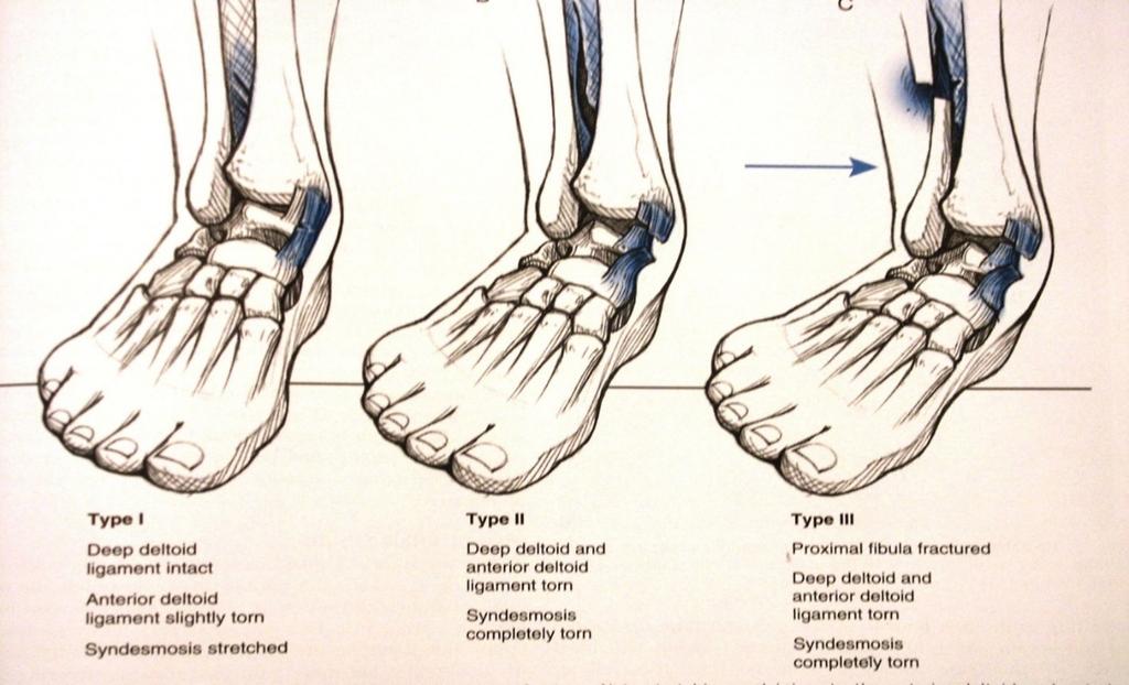 BIBLIOGRAPHY Arthroscopy with Ankle fractures: Amendola, A, et al Ankle Arthroscopy: Outcomes in 79 consecutive patients. Arthroscopy vol 12 (5):565-573.