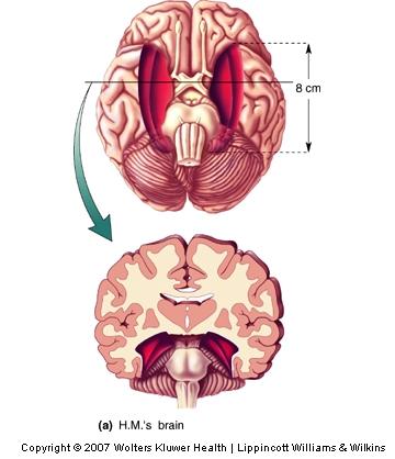 The Temporal Lobes and Declarative