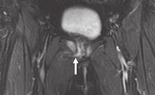 randon et al. Fig. 1 48-year-old woman 5 months after motor vehicle collision (anterior compression injury) with pubic bone and symphysis injury.