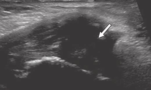 xial proton density weighted MR image with fat saturation shows osteitis pubis, with bilateral intense bone marrow edema of pubis bones (arrows) with
