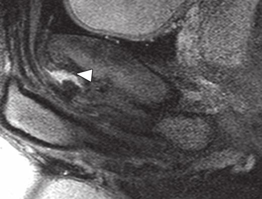 origin (arrow) on anterior inferior pubic tubercle.