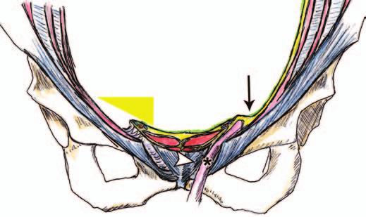 superficial ring (arrowhead). Inguinal triangle (yellow triangle, ) is medial and superior to canal. C Fig.