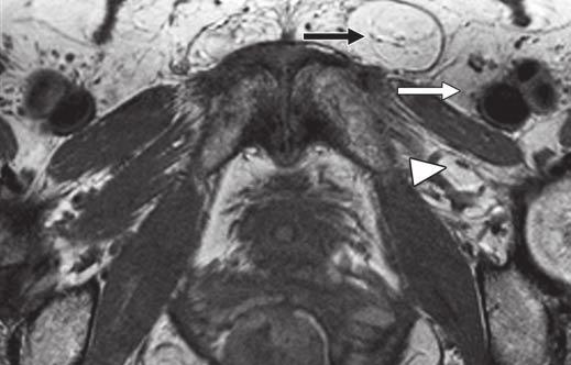 Groin Pain eyond the Hip Fig. 9 62-year-old woman with fat-filled obturator canal.