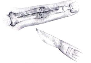 The extensor mechanism is exposed and incised longitudinally from its insertion at the base of the middle phalanx through the distal two-thirds of the proximal phalanx, taking care not to detach the