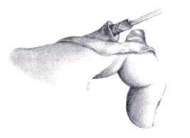 Do not rotate the bit back and forth as this will distort the canal and allow movement of the implant. Be sure that the dorsal mark on the broach handle faces the dorsal surface.