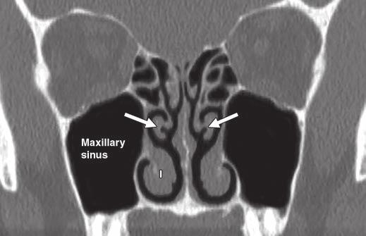 CT of Paranasal Sinuses and Nasal Cavity Fig.