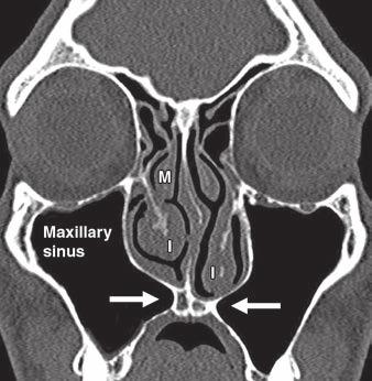 process of maxilla. M = middle turbinate, I = inferior turbinate. Fig. 6 49-year-old man with chronic sinusitis.
