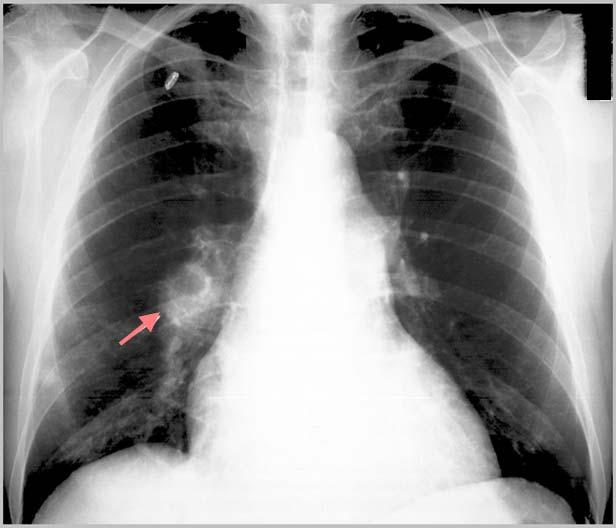 Patient 4: Enlarged Pulmonary Artery (15%) Dilated