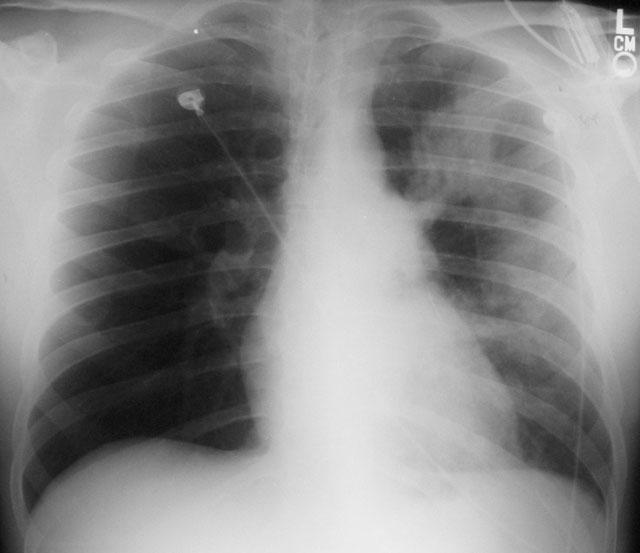 Patient 5: Oligemia of Lung (Westermark s sign) (5%) Oligemia of the Right lower lung occlusion of large lobar or