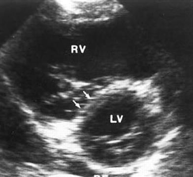 Patient 6: Echocardiographic features of PE Diastole Systole Transthoracic short axis