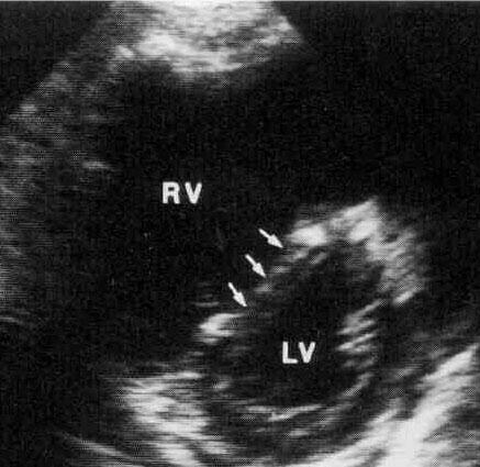 RV dilatation RV size does not change from diastole to systole = hypokinesis D-shaped LV