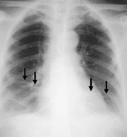 Patient 2: Atelectesis (68%) Chest radiograph: long
