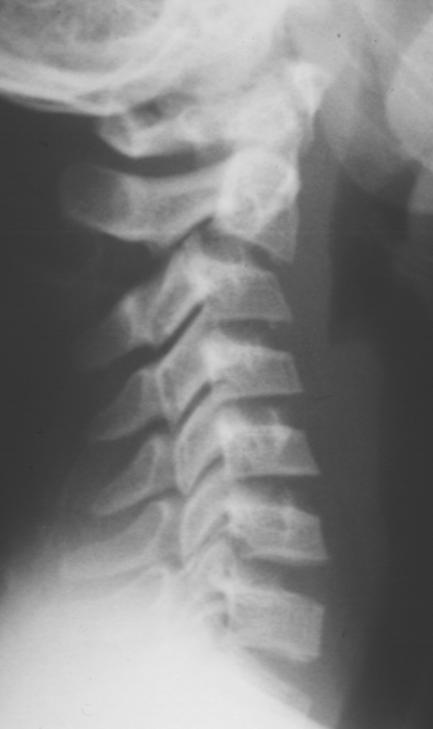 Injuries of the cervical spine Rare in