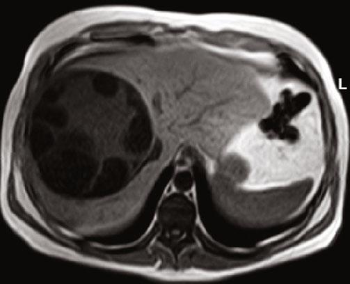 b On axial T1-weighted image, the hypointense rim is well visualized and the peripheral cysts are hypointense relative to the center of the lesion.