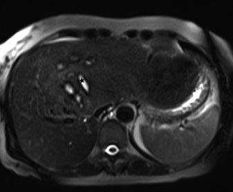 d On gadolinium-enhanced image, there is moderate and inhomogeneous enhancement. In a large, very inhomogeneous adenoma, malignant degeneration cannot be ruled out radiologically.