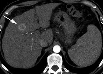 a Noncontrast CT shows liver cirrhosis and splenomegaly. In segment 4, a lesion is only faintly seen.