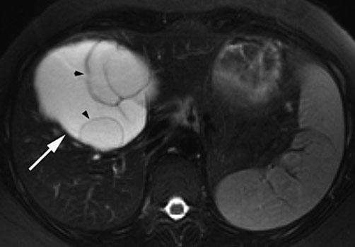 Intrahepatic CCC originates from the intralobular bile ducts (in contrast to hilar CCC, which arises from a main hepatic duct or from the bifurcation).