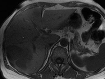 108 W. Schima, R. Baron a b c Fig. 20 a-c. Colorectal liver metastases at gadoxetic acid-enhanced MR imaging. a Unenhanced T1-weighted sequence shows two hypointense lesions in segments 6/7 and 4.