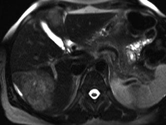 c Gadoxetic-acid-enhanced T1-weighted GRE image in the hepatobiliary phase shows two additional small subcapsular metastases (arrows) not seen on unenhanced MR imaging or MDCT (not shown) Fig.